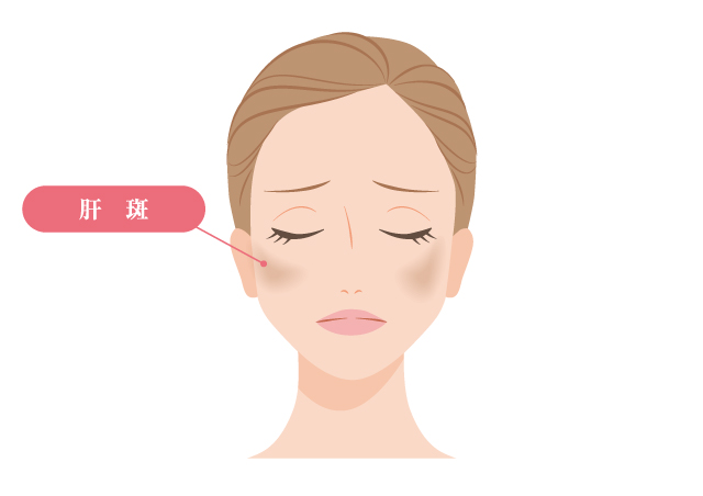 肝斑のイメージ