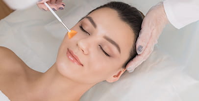 ケミカルピーリング