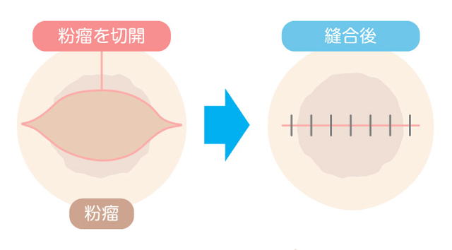 粉瘤の治療法