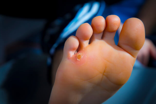 ウオノメができている足