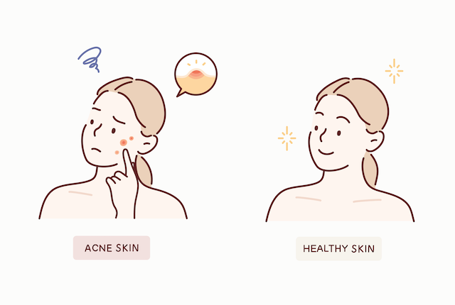 ニキビ肌と健康な肌イラスト