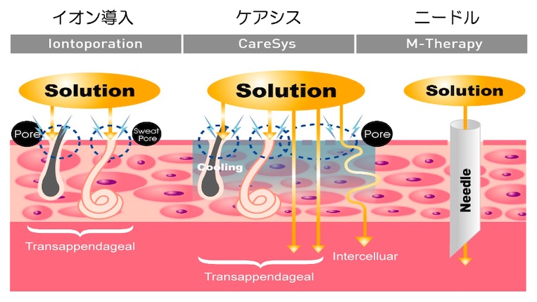 ケアシスSとイオン導入の違い