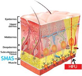 SMAS筋膜イラスト
