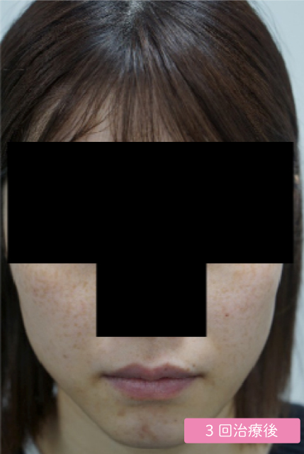 症例① 3回治療後