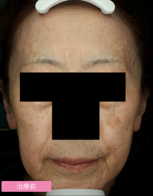 症例② 治療前