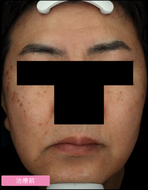 男性の肌診断写真 治療前