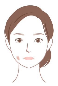 炎症性色素沈着のイラスト