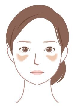 肝斑のイラスト