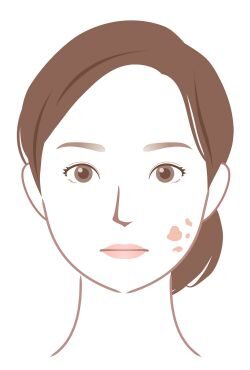 老人性色素班のイラスト