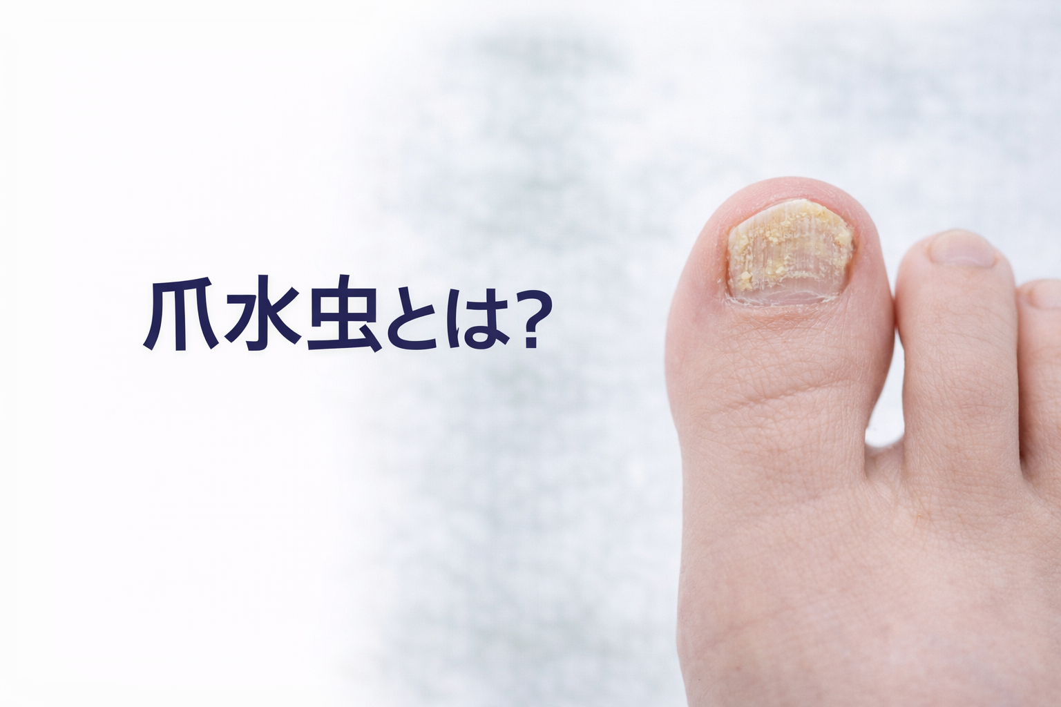 爪水虫（爪白癬）とは？　爪が厚くなる原因を皮膚科医が解説