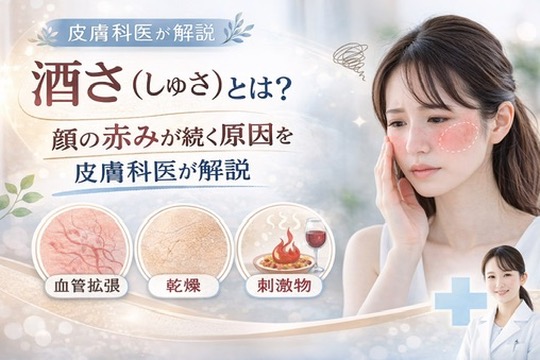 酒さ（しゅさ）とは？顔の赤みが続く原因を皮膚科医が解説