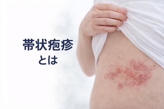 帯状疱疹とは？　初期症状と早期治療の重要性を皮膚科医が解説