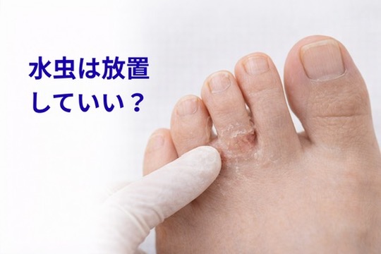 水虫は放置していい？ 症状と受診の目安を皮膚科医が解説