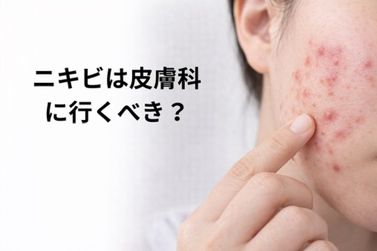 ニキビは皮膚科に行くべき？市販薬との違いを皮膚科医が解説