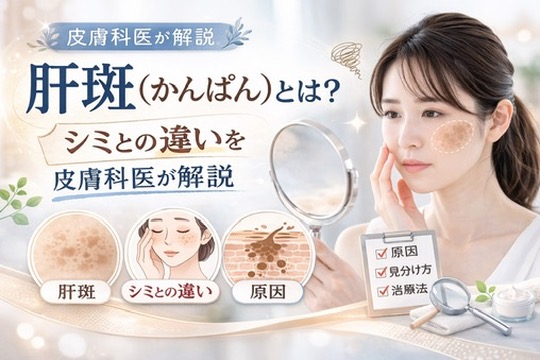 肝斑（かんぱん）とは？　シミとの違いを皮膚科医が解説