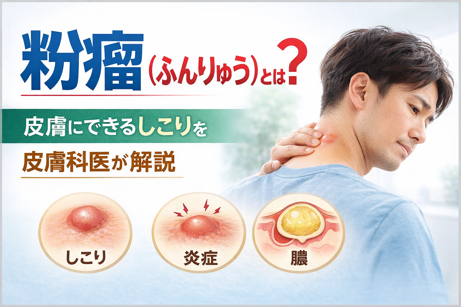 粉瘤(ふんりゅう)とは? 皮膚にできるしこりを皮膚科医が解説