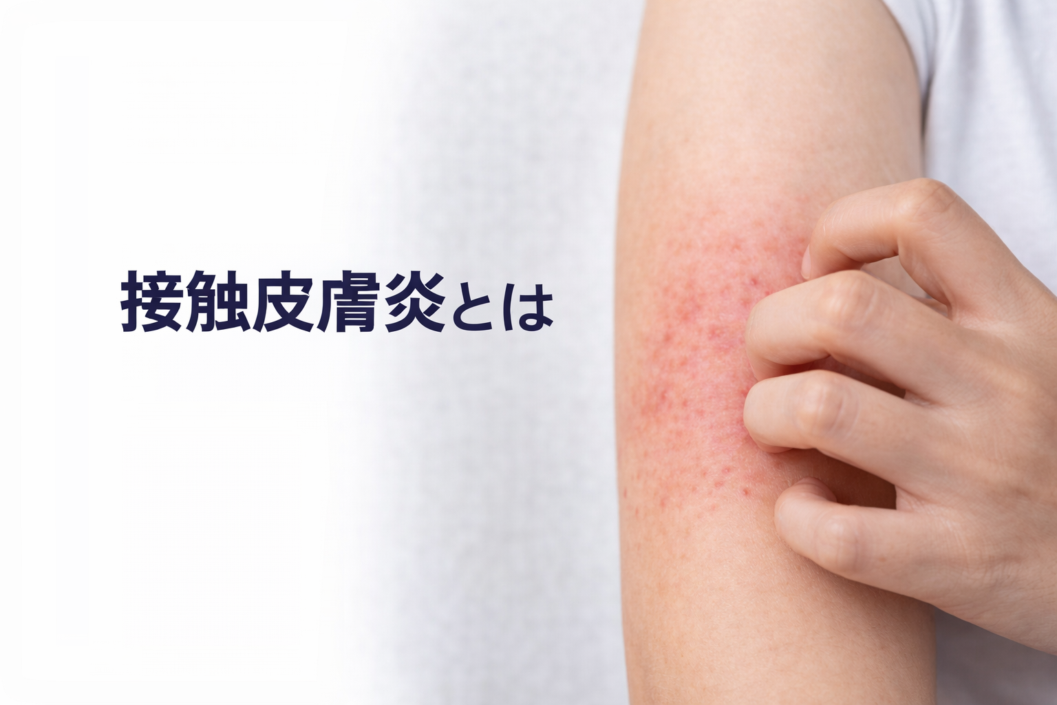 接触皮膚炎（かぶれ）とは？ 原因と治療を皮膚科医が解説