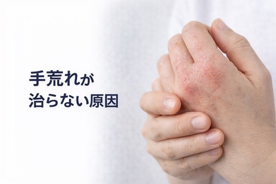 手荒れが治らない原因｜皮膚科医が解説