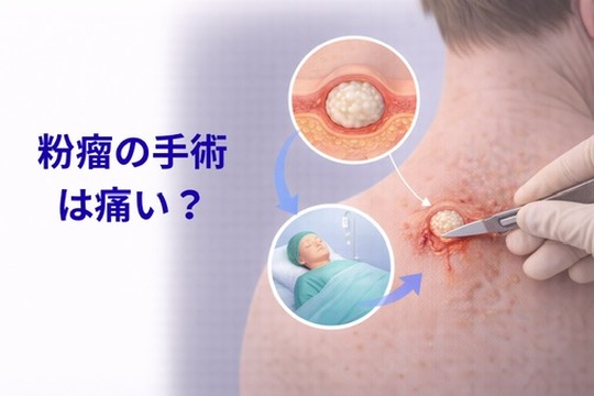 【札幌の皮膚科医が解説】粉瘤の手術は痛い?日帰りできる?治療の流れ