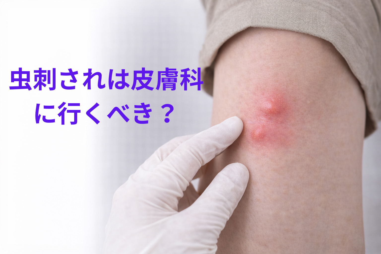 虫刺されは皮膚科に行くべき? 受診の目安と対処法を皮膚科医が解説