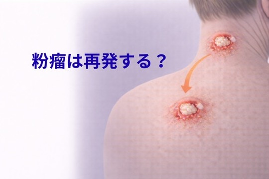 【札幌の皮膚科医が解説】粉瘤は再発する？原因と予防、再発しないためのポイント