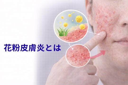 花粉皮膚炎とは？ | 症状と対策を皮膚科医が解説